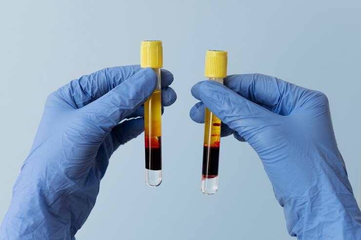 Sodium fluoride heparin lithium blood collection tubes